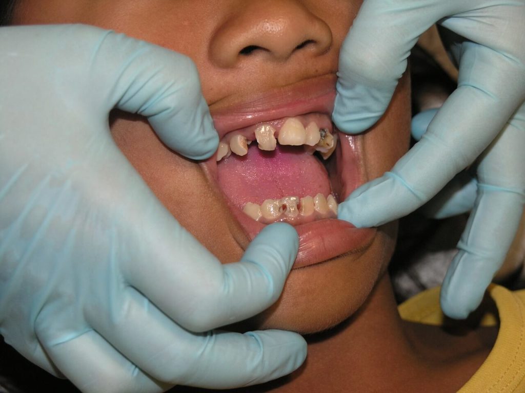 Schlechte Zähne und Zahnschmerzen