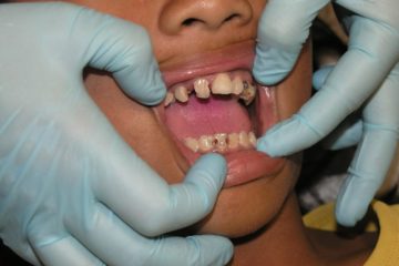 Schlechte Zähne und Zahnschmerzen